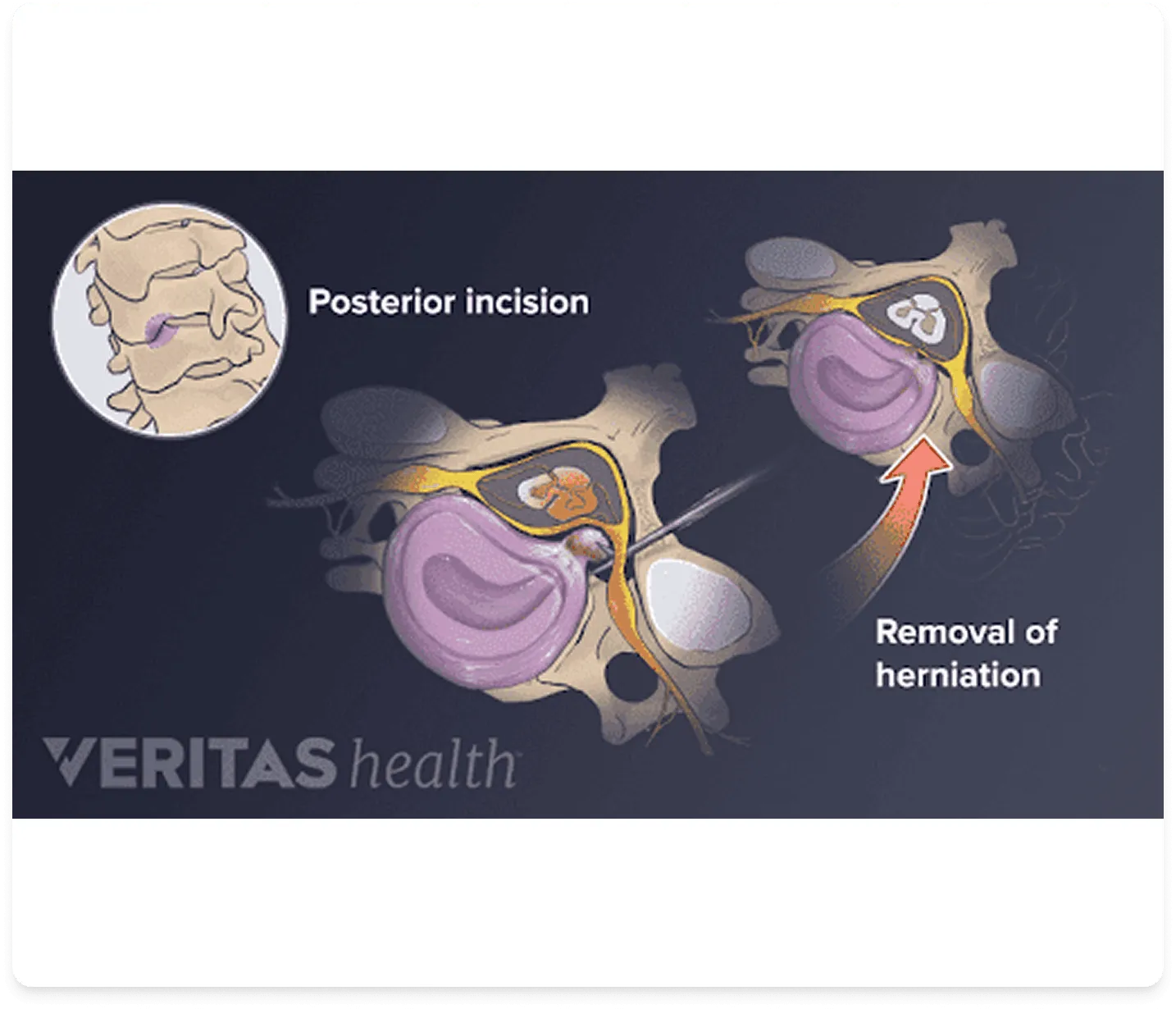 Sciatica pain symptoms