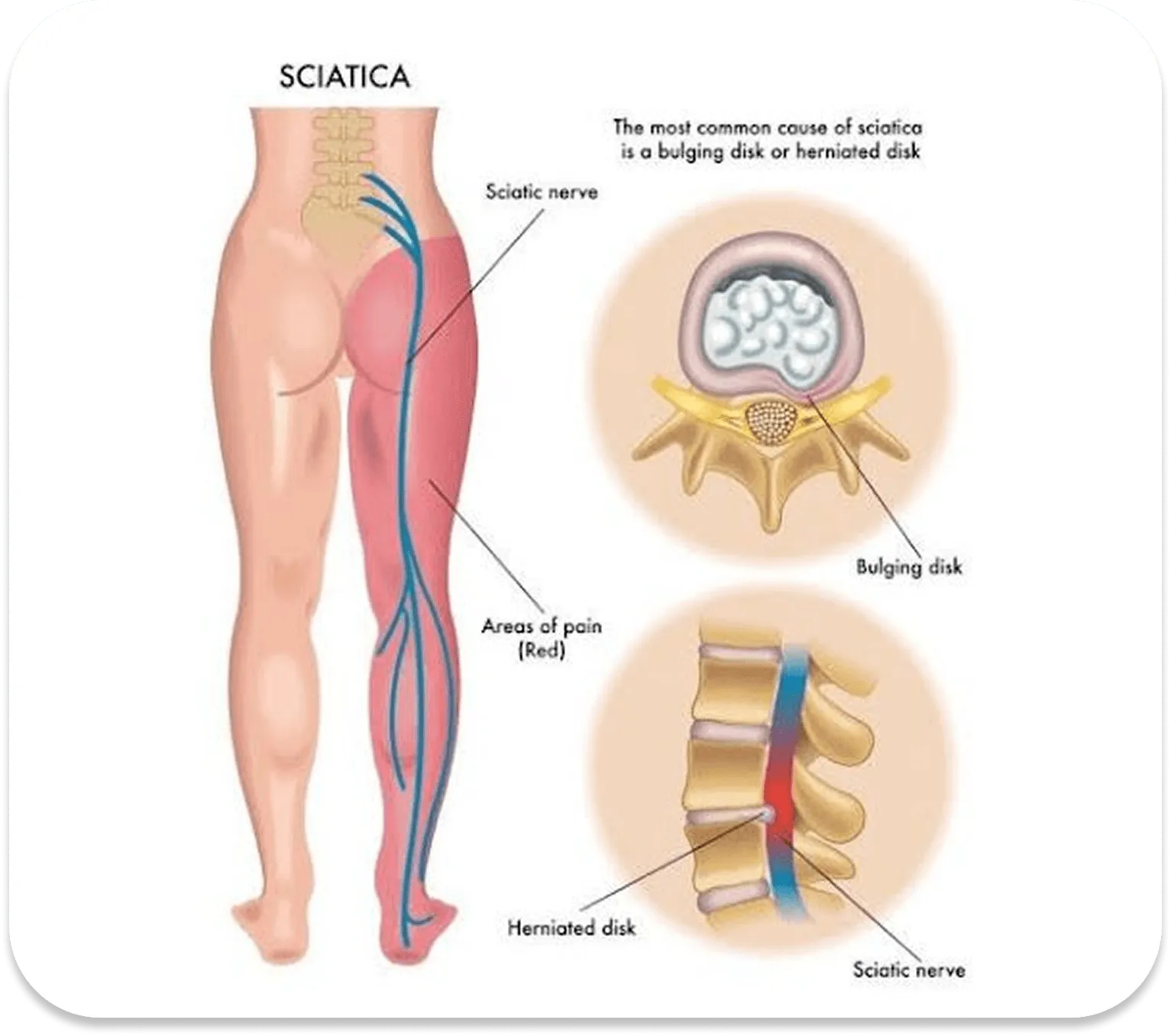 Sciatica and spinal disc conditions
