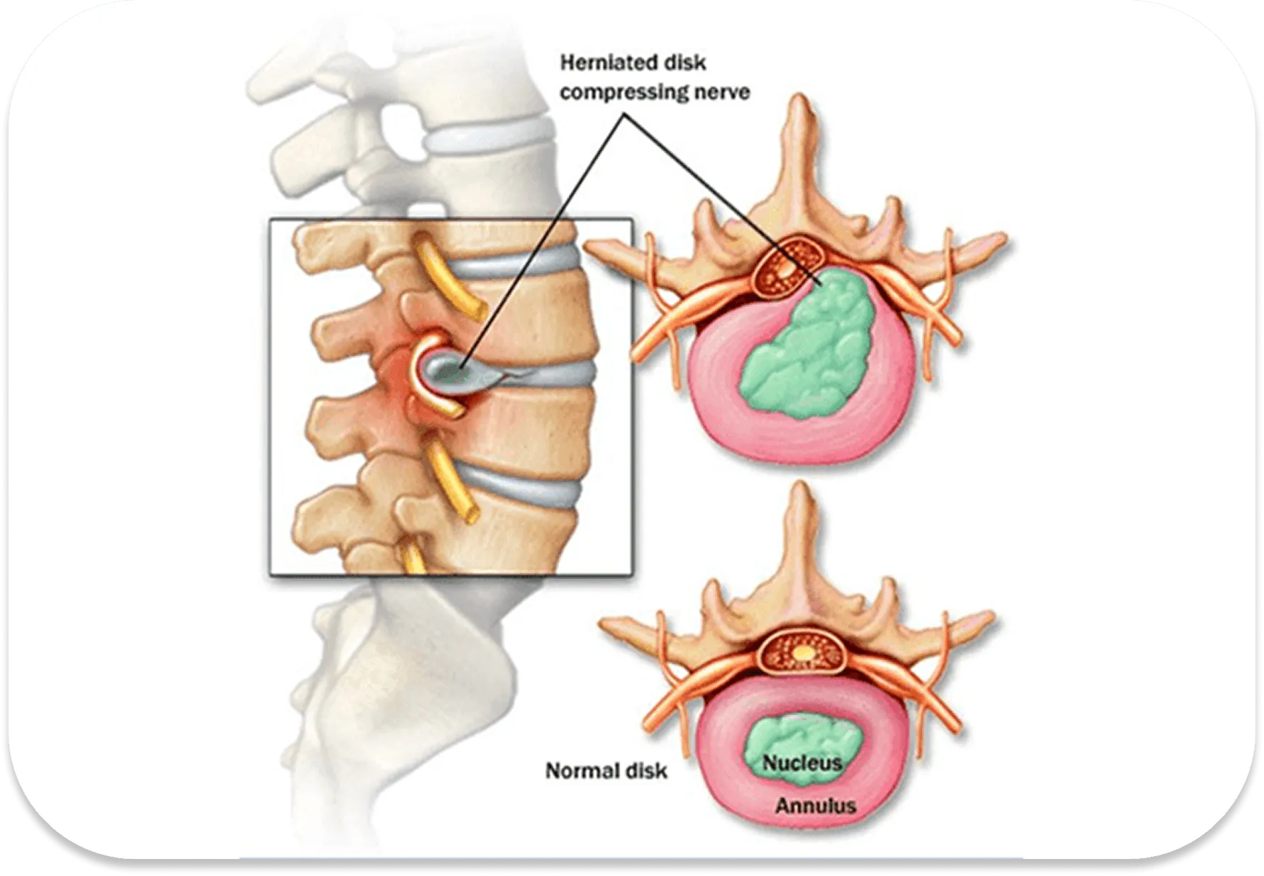 Herniated disc compressing nerve compared to normal disc anatomy